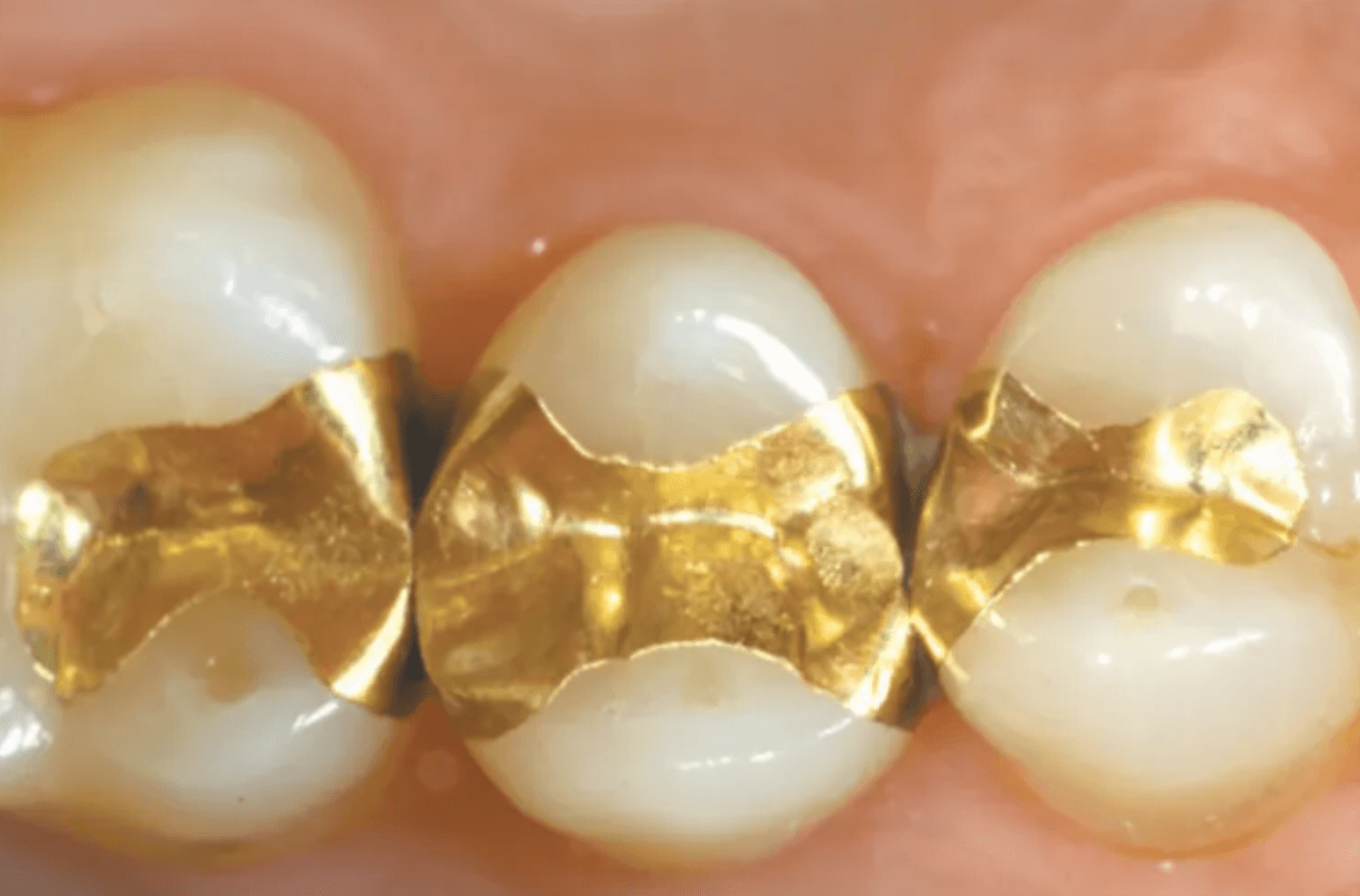 골드 인레이 가격