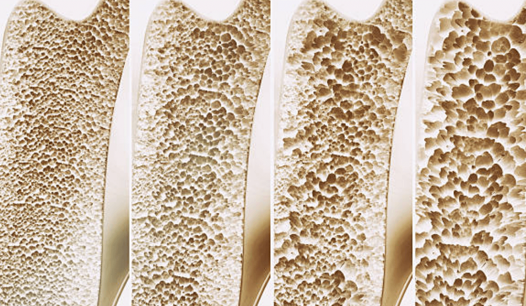 골다공증 검사비용