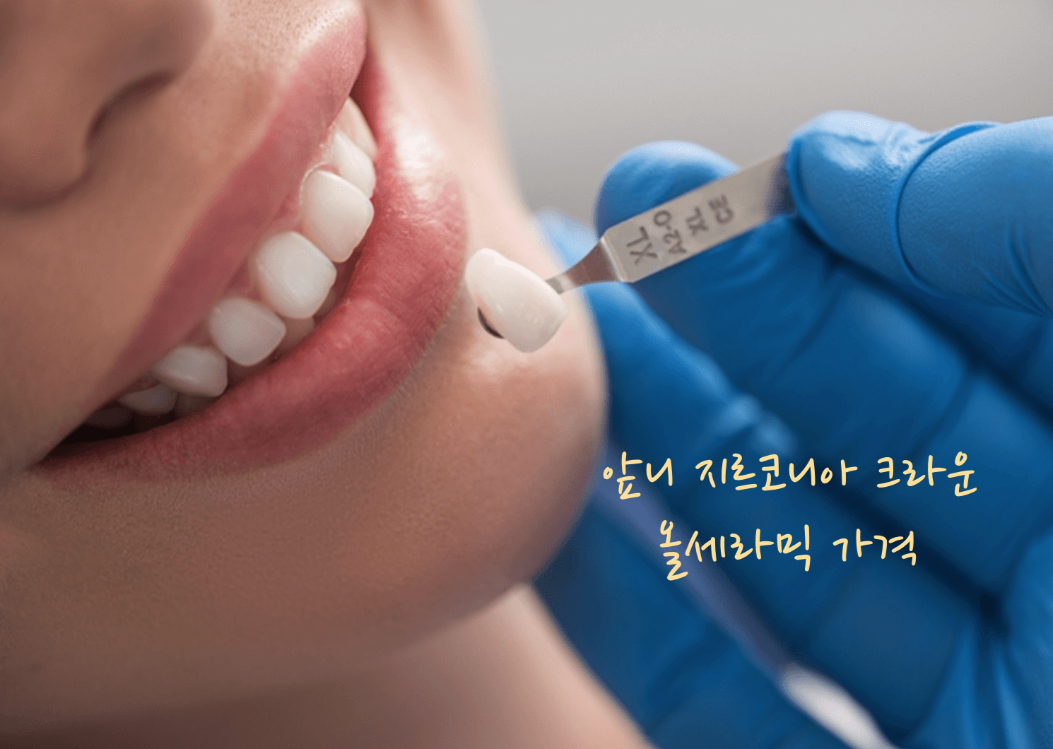 앞니 크라운