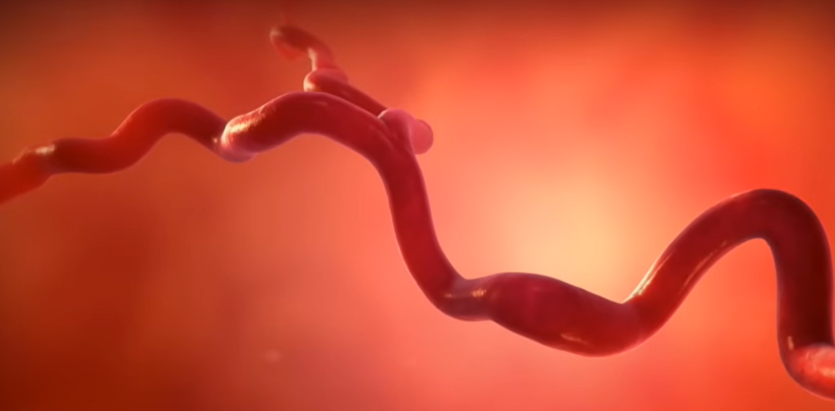 뇌경색 전조증상