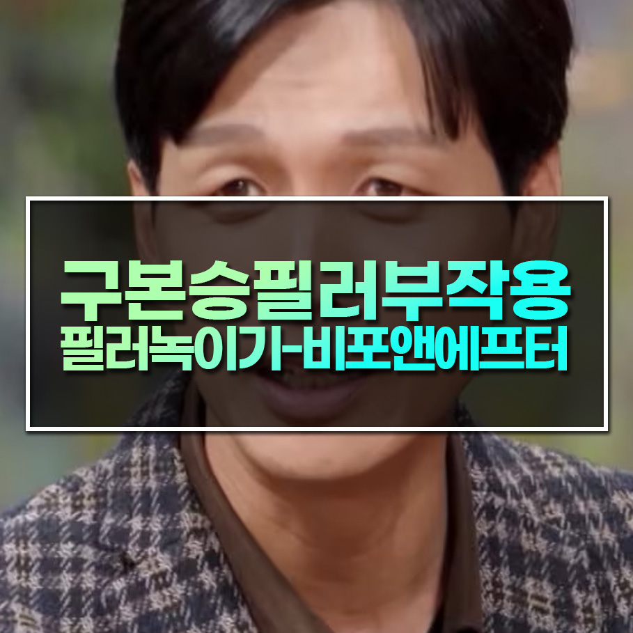 구본승 필러 부작용..필러 녹이기 비포앤에프터