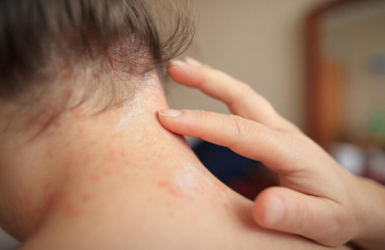 땀띠 치료 가라앉히는 방법 5가지