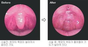 코골이 수술