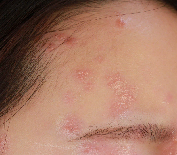 대상포진-초기증상-건강