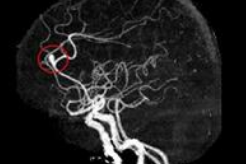 뇌동맥류 초기 증상