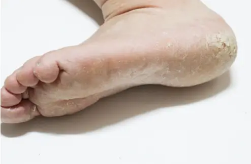 무좀약 바르는 범위