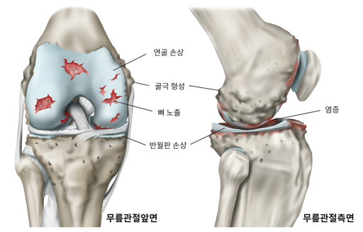 관절경수술 후 물리치료 운동 가이드