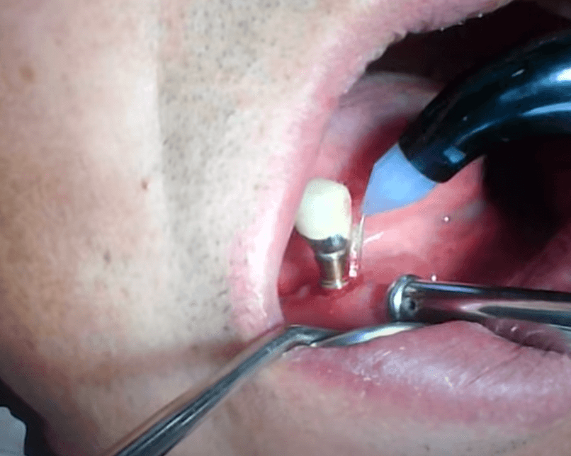 임플란트 주위염 ; 증상&amp;#44; 원인&amp;#44; 예방 및 관리방법 알아보기(재수술&amp;#44; 부작용&amp;#44; 재식립)