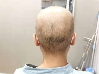 항암-치료로-머리카락이-다-빠지는-뒷모습