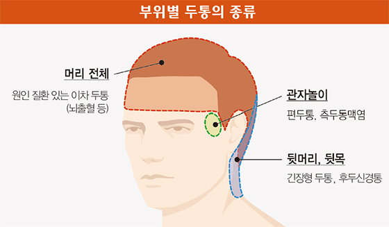 두통의종류