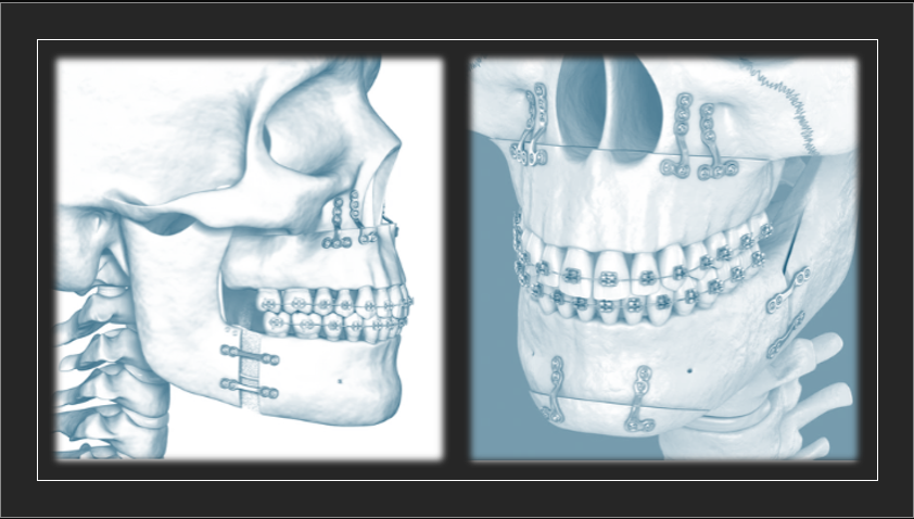 양악수술의 현주소와 변화