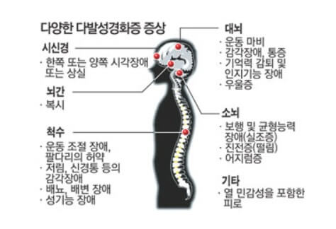다양한 다발성경화증 증상