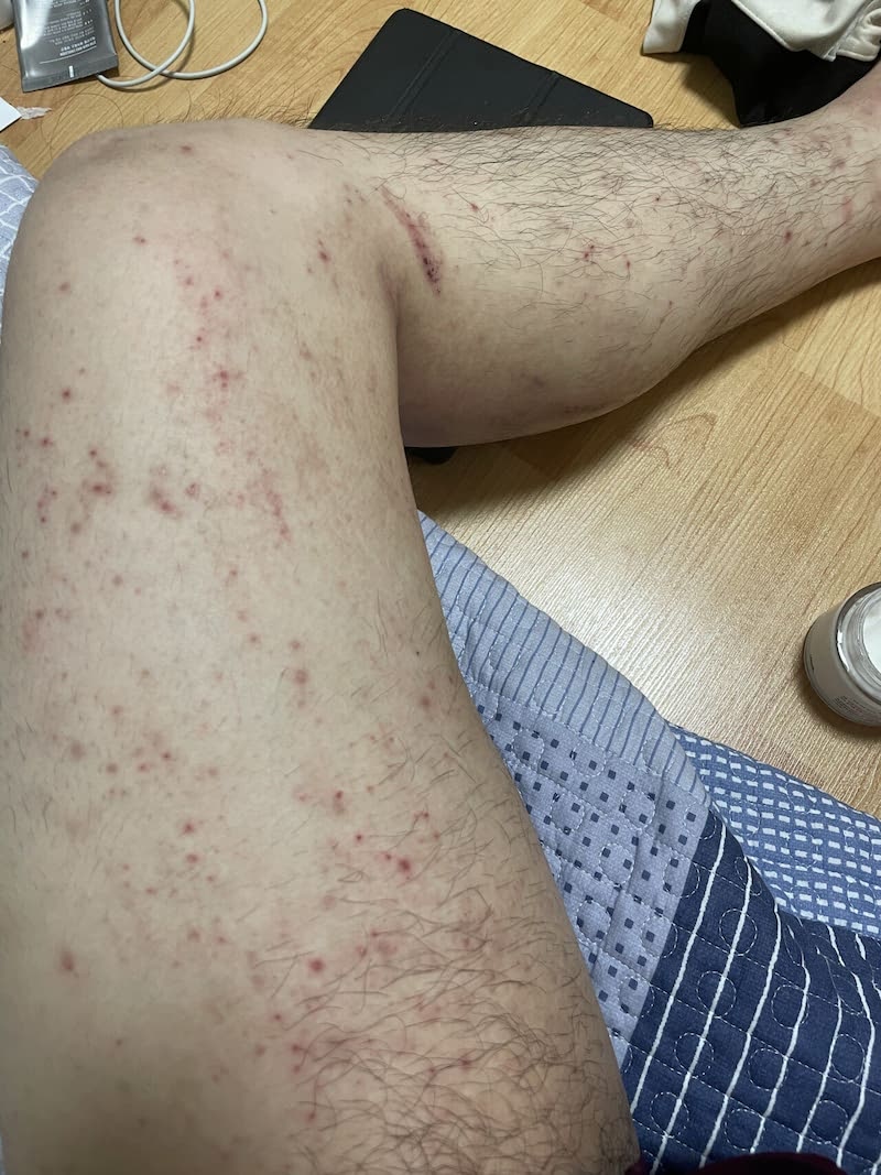 화이자 백신 접종 후 전신 두드러기와 피부 발진 가려움증