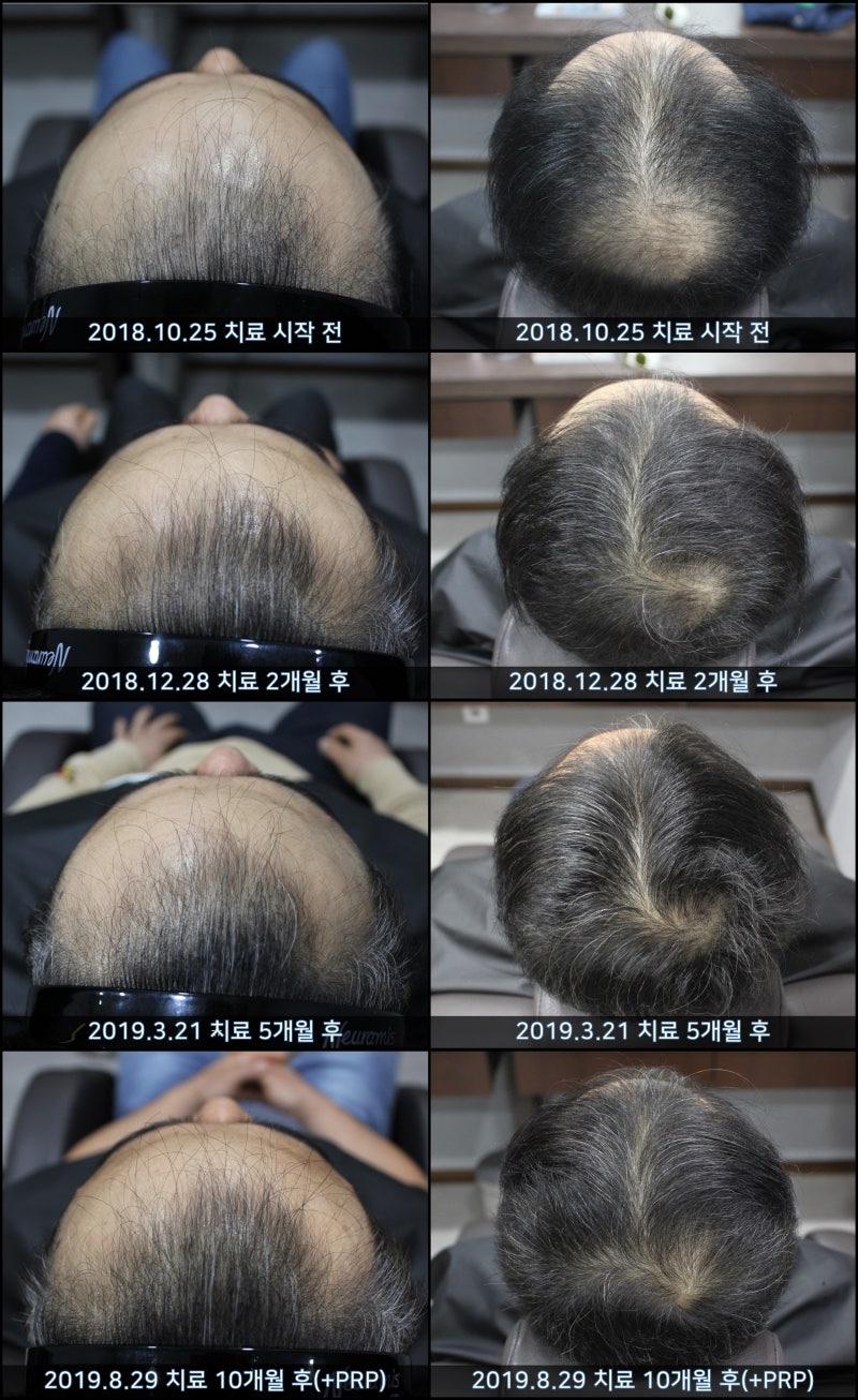 PRP 치료 탈모