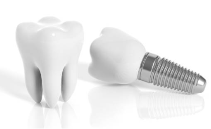 임플란트 종류가격차이점