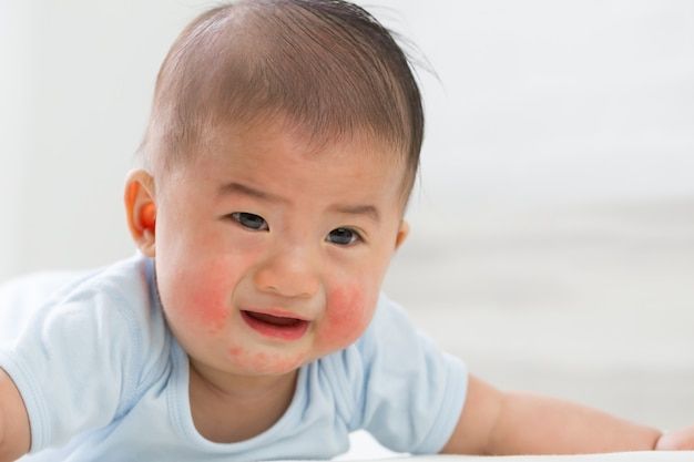 아토피 예방법