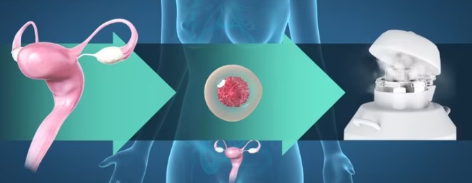 난자냉동(난자동결) 보관- 시술비용&#44; 지원 기간 / 난자생존기간&#44; 난자채취 후 통증&#44; 생리&#44; 음식&#44; 운동