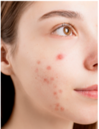 여드름은 피부의 피지선이 막혀 발생하는 흔한 피부 문제로, 적절한 홈케어를 통해 개선할 수 있습니다. 여드름 피부를 위한 홈케어 방법을 소개합니다.