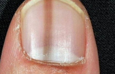 손톱검은세로줄 방치하면 생기는 문제 (암, 초기징후, 예방)