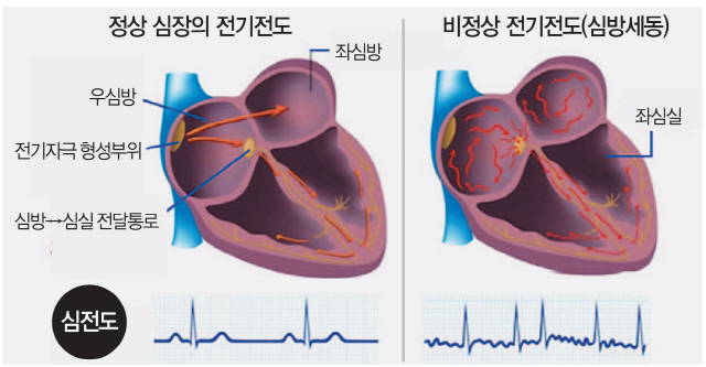 심방세동 치명적 위험과 뇌졸중 발생률 증가 관련 이미지