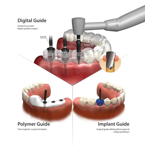 덴티움 디지털가이드