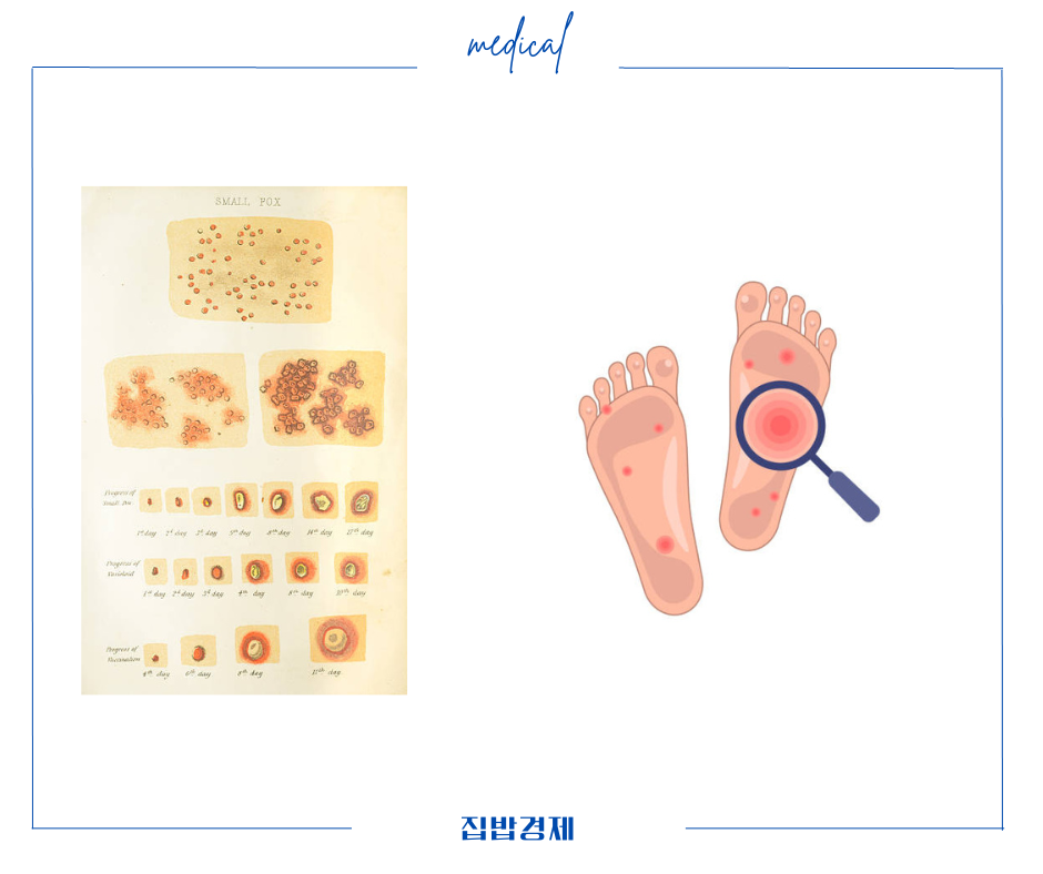 카네스텐 연고 부작용