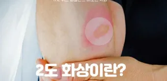 2도 화상 증상 자가치료 회복기간 응급처치법 정리_11