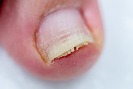 조갑박리증 (Onycholysis) &ndash; 손톱&middot;발톱 들림 증상과 치료