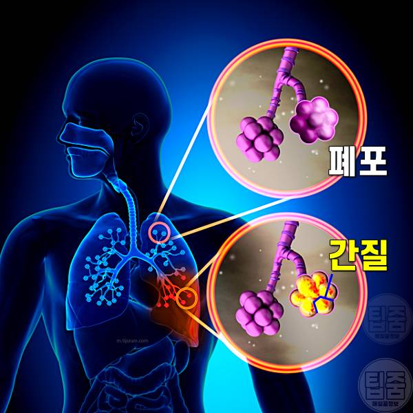 폐 굳는 병 폐섬유증 증상 폐암 전단계 코로나후유증