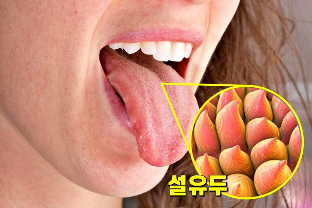 혀에 백태가 끼는 이유, 구강칸디다증