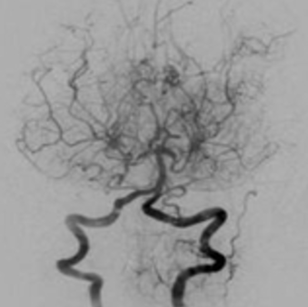 모야모야병-증상-원인-유전-합병증-완치율-예방법