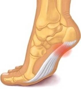 족저근막염 증상