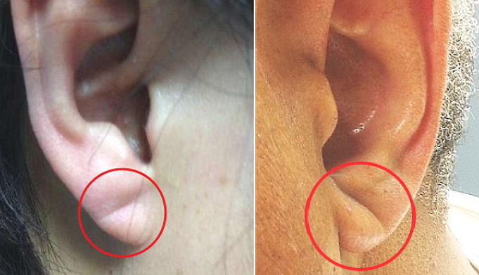 뇌졸중 귓볼주름