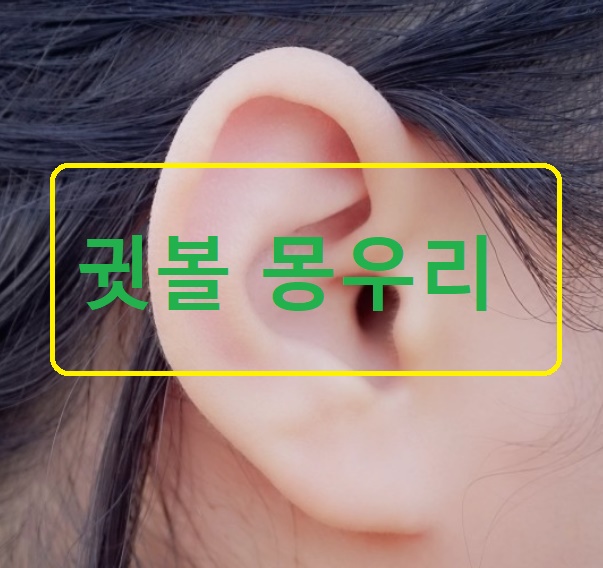 귓볼 몽우리 원인