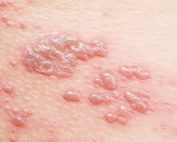 대상포진-초기증상-피부