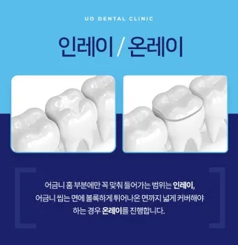 인레이 온레이의 차이와 치료 방법_7