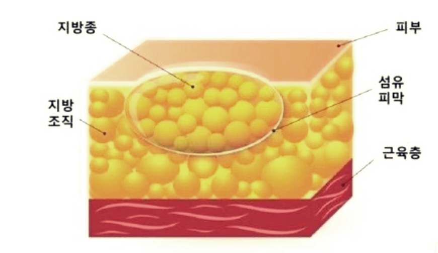 지방종 제거 수술: 원인, 절차, 비용