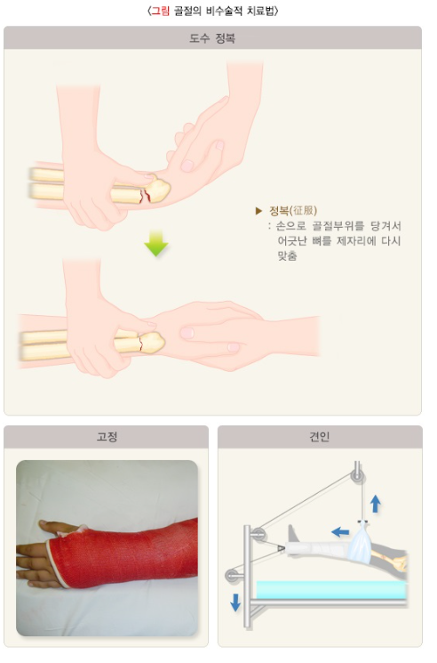 골절의 비수술적 치료