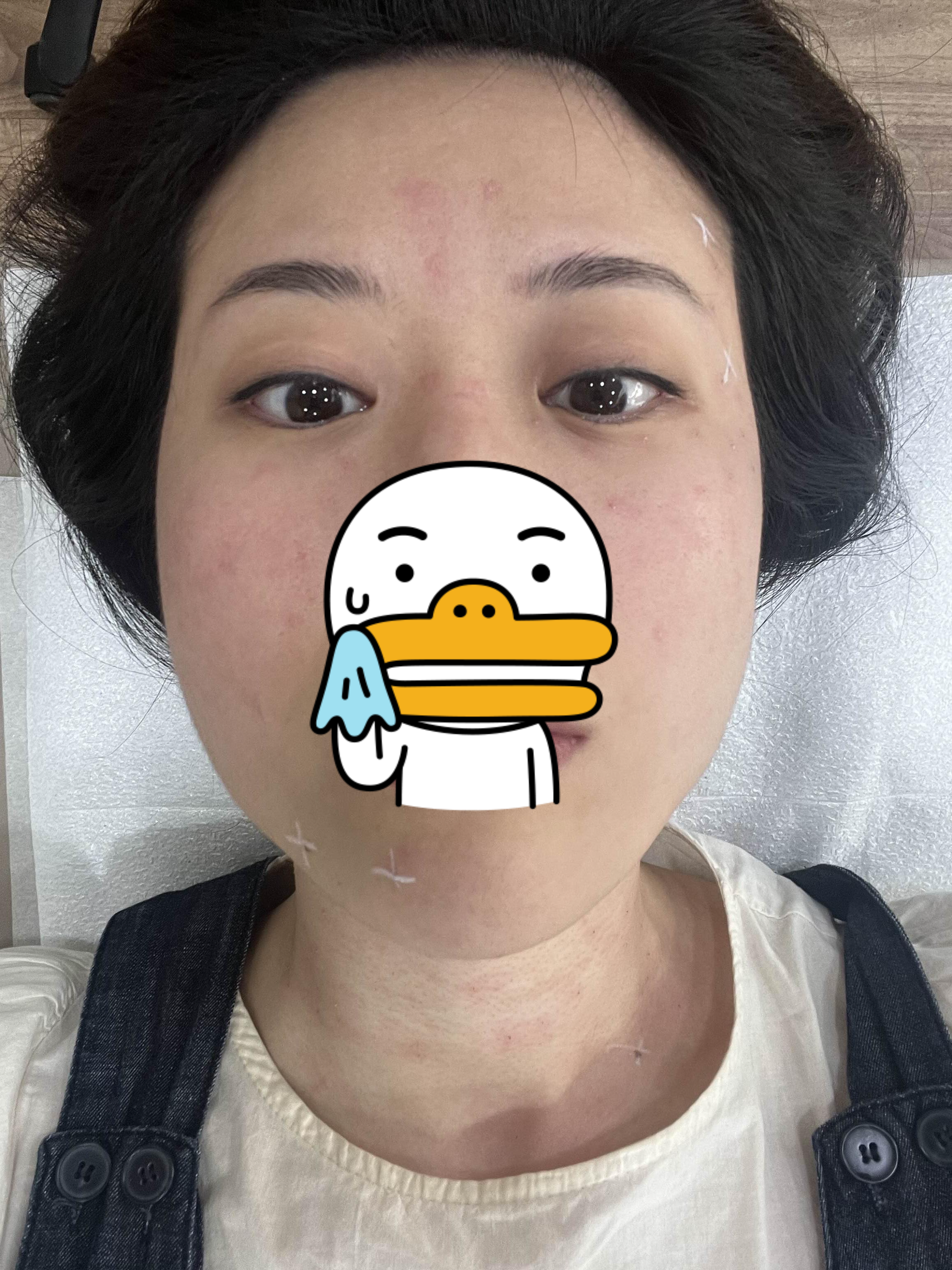 편평사마귀 치료 평평사마귀