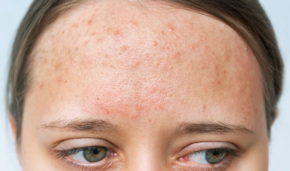 이마에 난 여드름