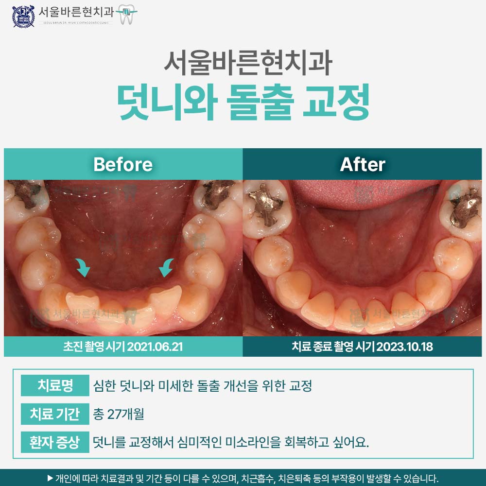 해운대돌출입교정