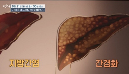 지방간염-간경화