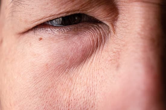 눈밑 지방 재배치: 절차와 효과