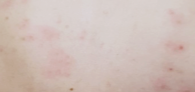 피부에-빨갛고-넓게-번진-발진