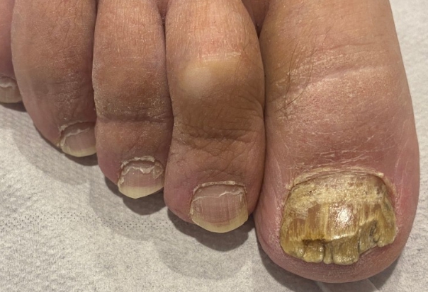 발톱무좀 가이드