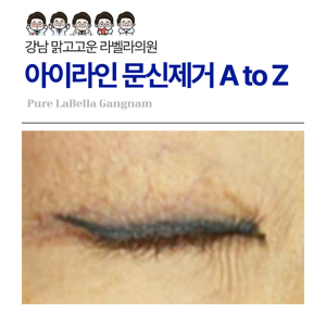 아이라인 제거