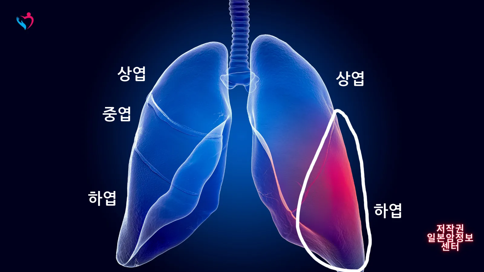폐암 증상 원인 검사 치료
