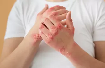 대상포진