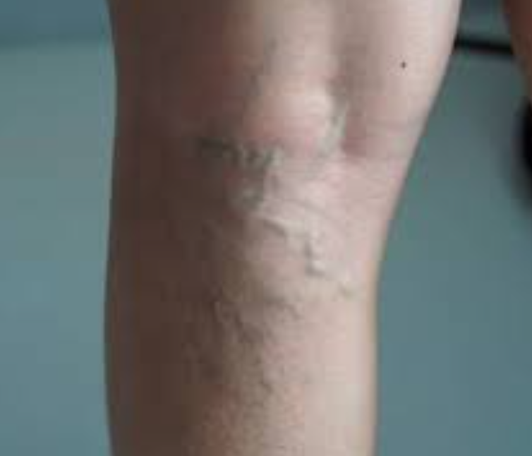 하지정맥류 초기증상과 치료 및 예방