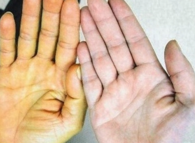 카로틴혈증의 치료법